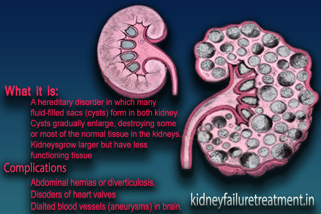 Ayurvedic Polycystic Kidney Disease (PKD) Treatment