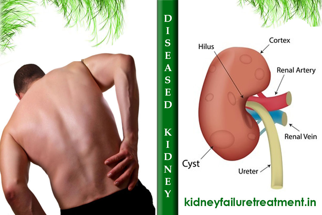 kidney disease treatment in Surat