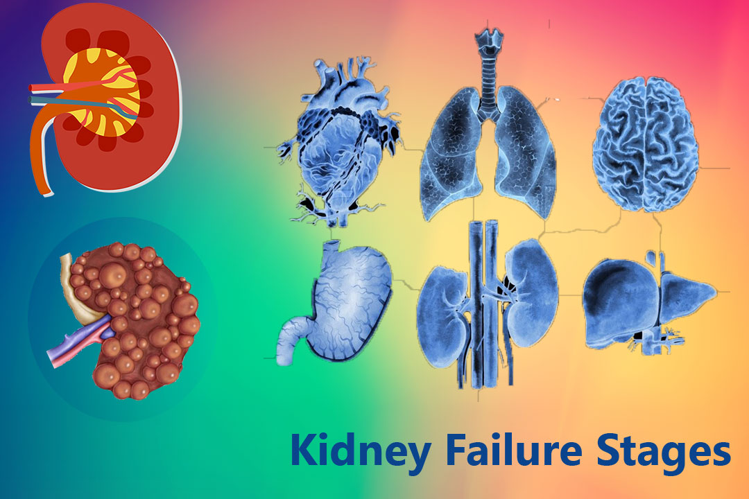kidney stages of death