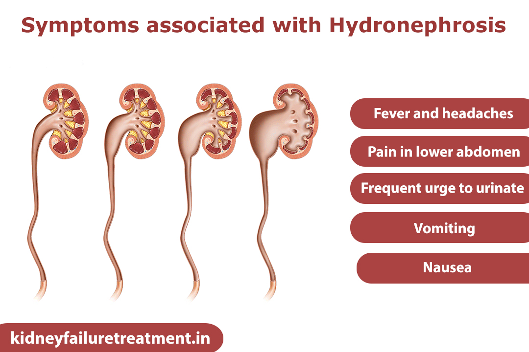 Hydronephrosis treatment in Ayurveda