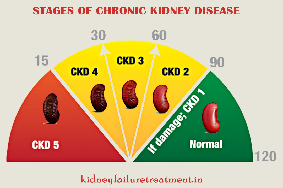 ICD-10 Chronic Kidney Disease Stage 2