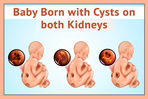Right treatment for baby born with cysts on both kidneys