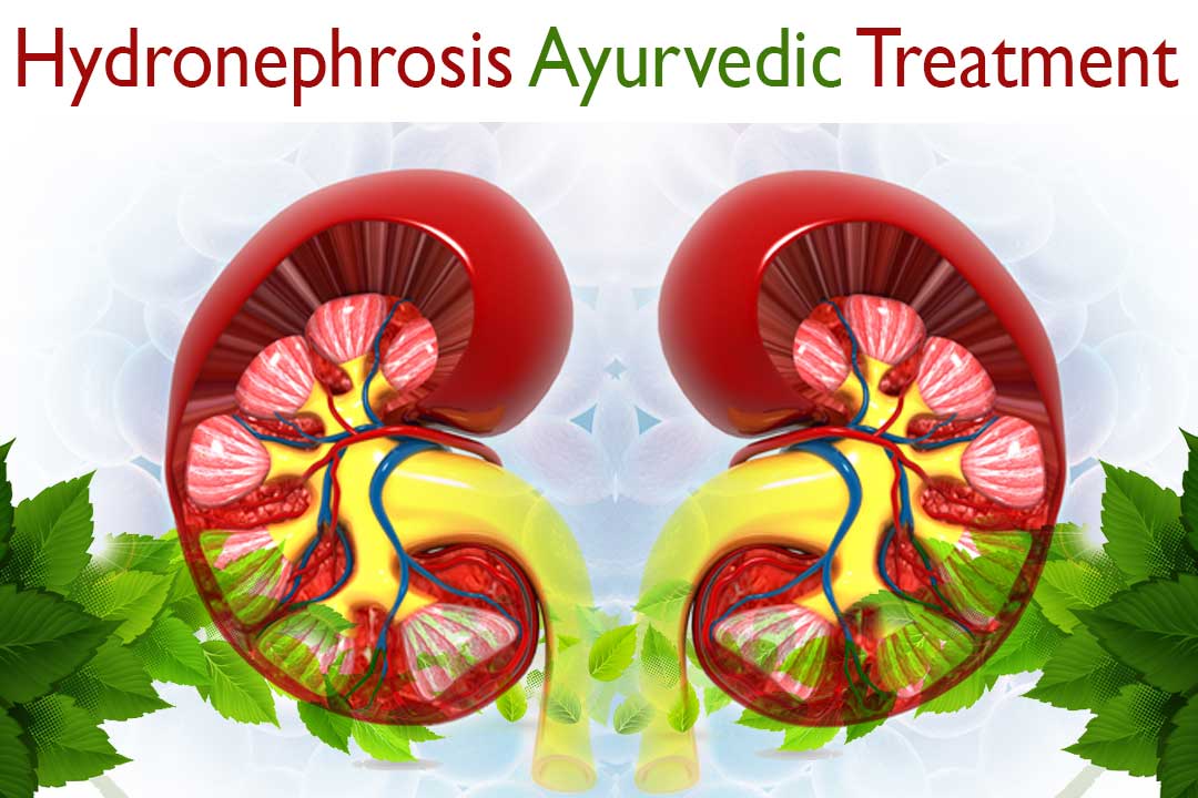 Hydronephrosis Ayurvedic treatment