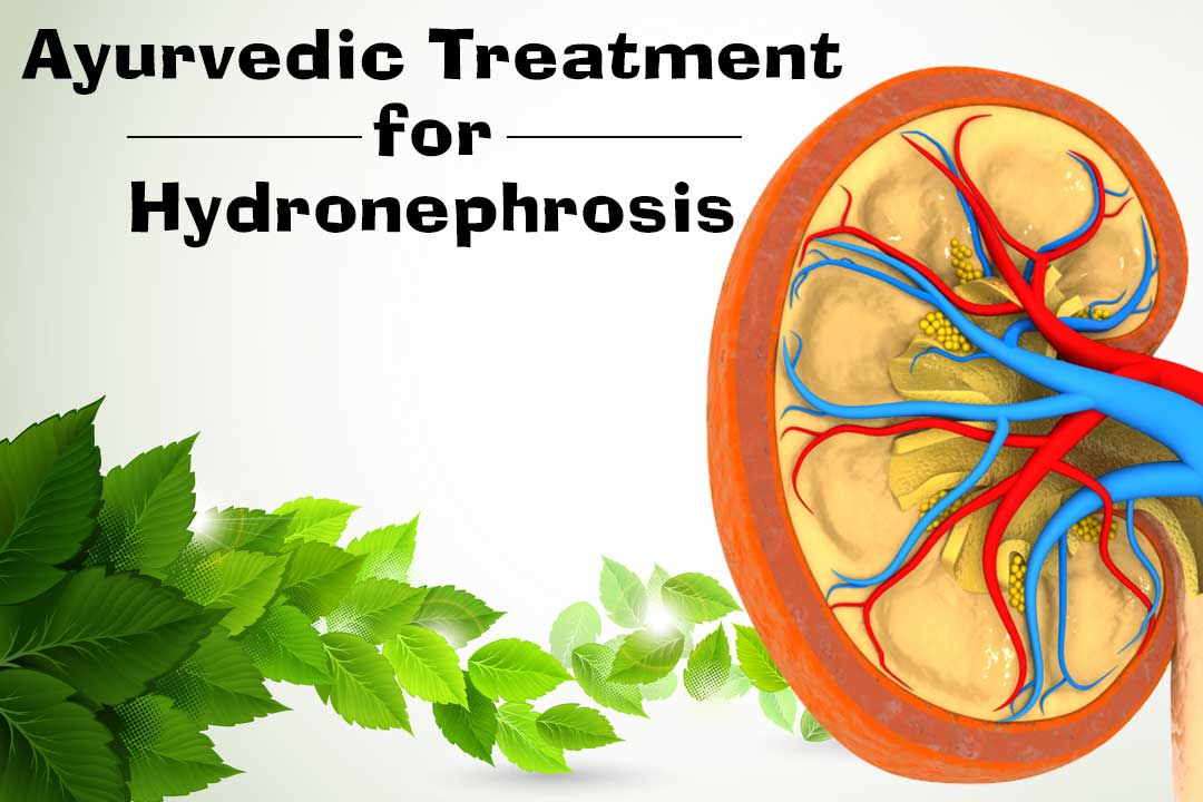Ayurvedic treatment for Hydronephrosis
