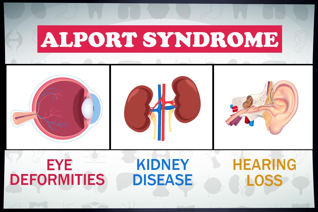 Alport syndrome